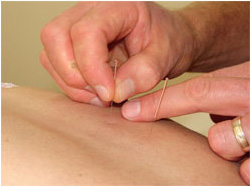Miramar Physio Acupuncture